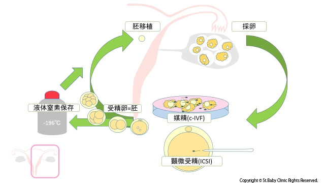 高度不妊治療のプロセス